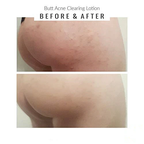 Private Label Butt Acne Lotion Formulated Specifically For The Buttocks