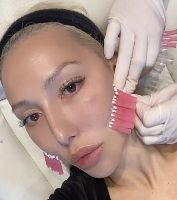 baby face pcl polylactic acid 30G  38mm mono threads south korea facial threads