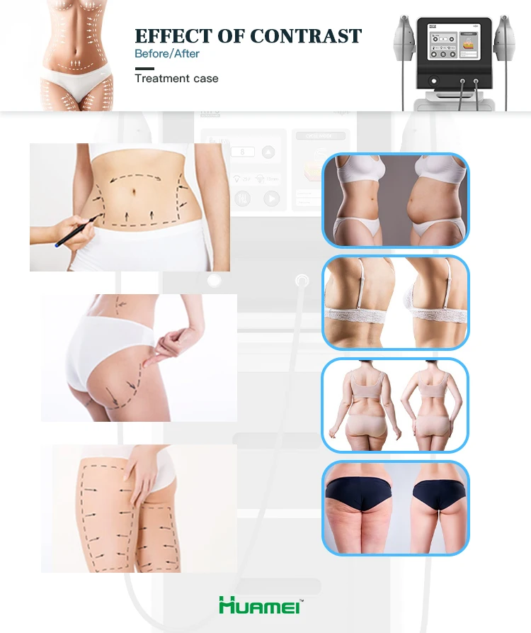 Оборудование для салонов красоты hifu body slim похудения/высокоинтенсивный сфокусированный ультразвук продажи