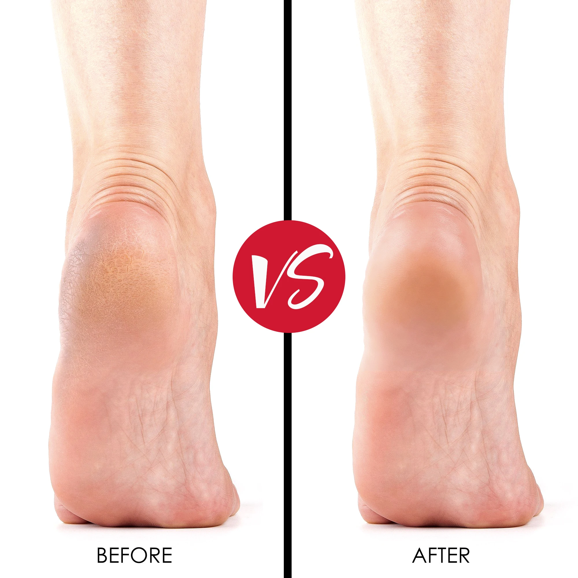 Customized Factory Price Extra Strength Foot Exfoliator Gel Remueve Callos Salon Grade Home Pedicure Supplies Callus Remover Gel