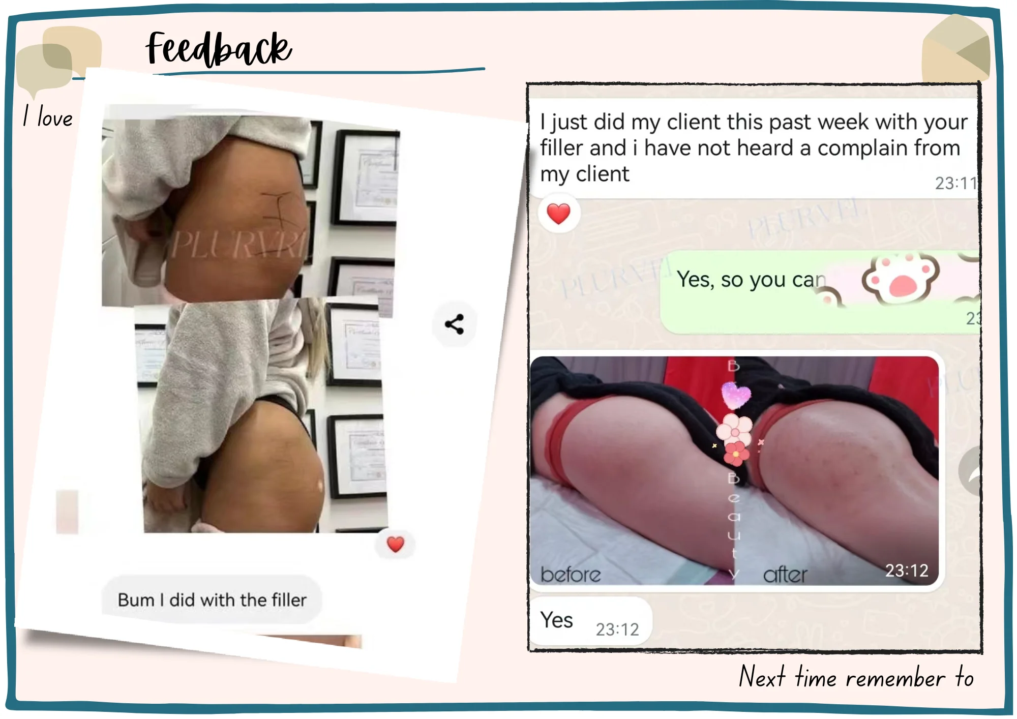 Fast shipments Subskin 10ml  Hyaluronic Acid Injection Dermal Filler Hyaluronate Gel Injections Buttock Breast Dermal Filler