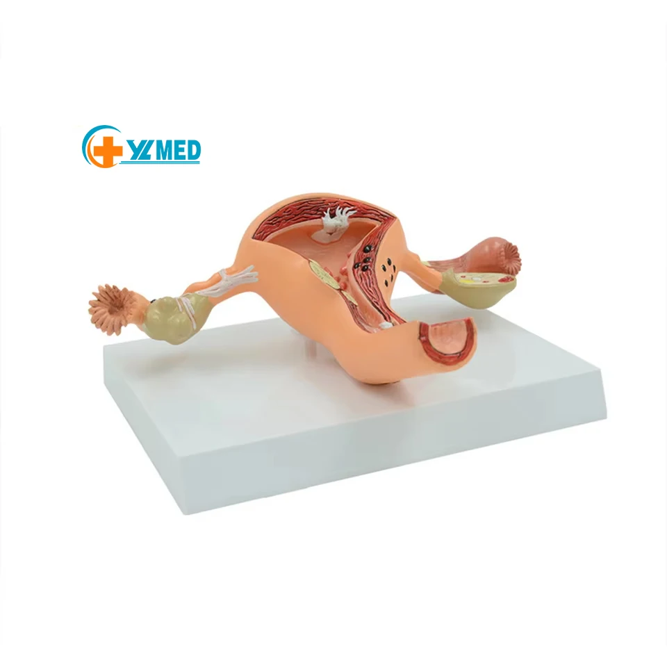 Медицинская школа учит человеческую модель патологических изменений женской репродуктивной матки и модели яичников