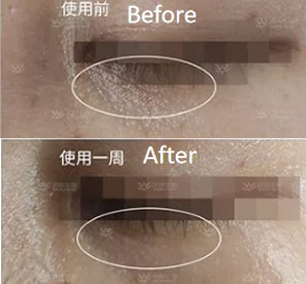 New Arrival Anti Wrinkle Soluble Microneedling Patch Under Eye Dissolving Hyaluronic Acid Microneedle Eye Mask Patches