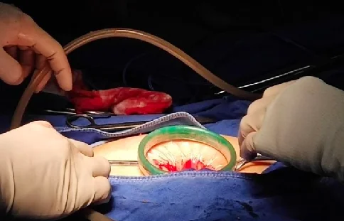 Medical Surgical Disposable Wound Retractor