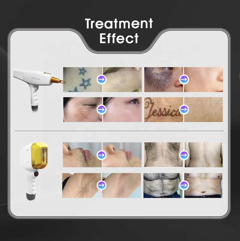 Most advanced ! 2 in 1 nd yag tattoo removal diode laser 808nm laser hair removal machine 755 808nm 1064 for sale factory price