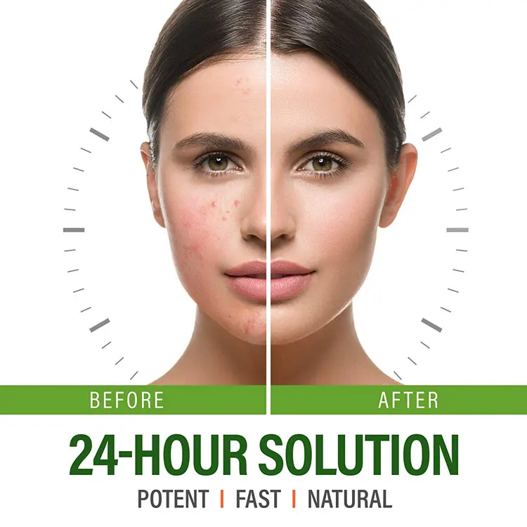 
Face Tea Tree Pimples And Dark Spot Removal Salicylic Acid Anti Scar Best Pimple Remove Acne Cream 