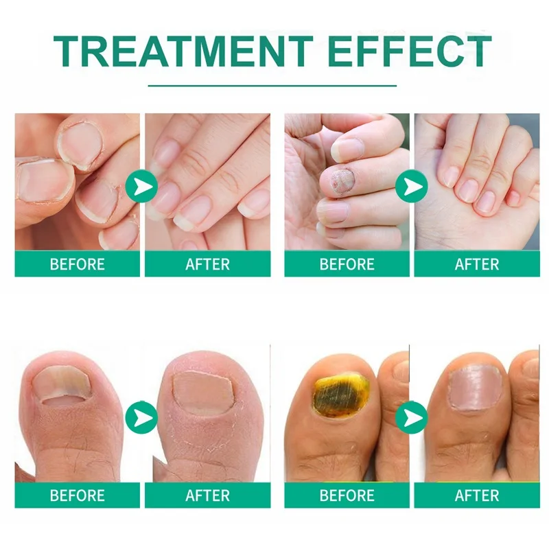 Organic Fungus Nail Repair Essence Toe nail Fungus Remover Treatment Solution