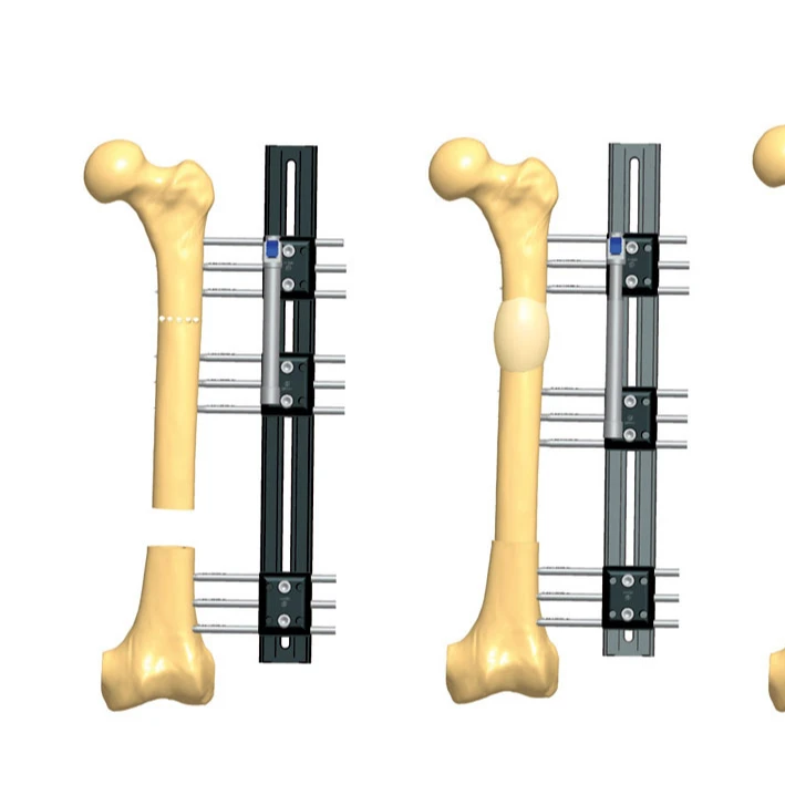 Bone Lengthening External Fixator