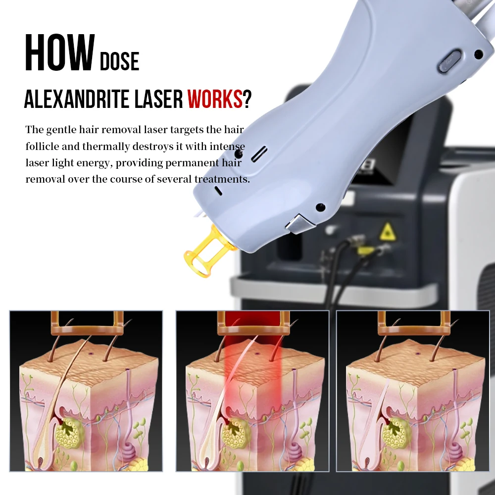 Factory price professional Long Pulse alex nd yag gentle machine max 1064nm 755nm alexandrite laser hair removal for sale