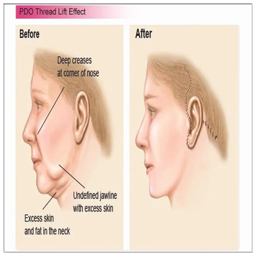 
Fast free shipping Korea PDO face lift thread 4D Cog 21G60mm with Blunt L needle for Fox eye lifting 