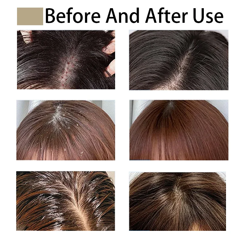 ZS Wholesale Scalp Relief Anti-Dandruff Lyophilized Powder Follicle Repair Deep Cleaning Anti-Hair Loss Hair Growth Serum