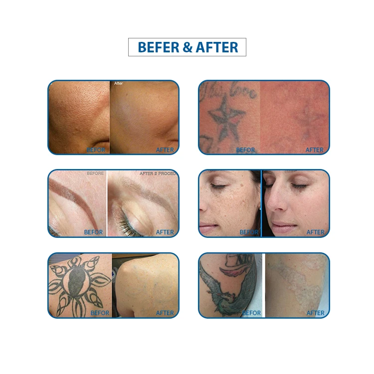 2025 Professional Wholesale Price Q-switch Nd Yag Portable Laser Tattoo Removal Machine nd yag laser for sale