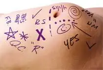 2022 Wholesale High Quality Surgical Skin Marker Pen Sterilized Bag Packaging Customized Skin Marker Pen