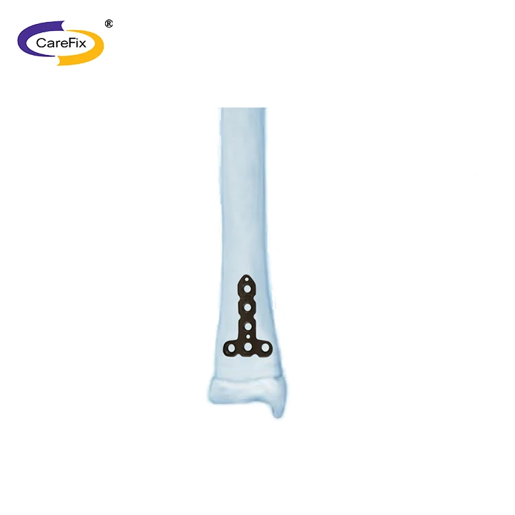 orthopedic implants titanium manufacturers Fixation Reduction Ergonomic Design