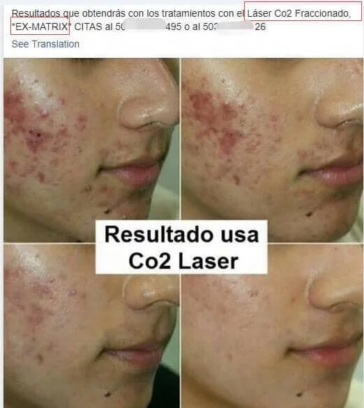 Med Spa use Medical grade Fractional CO2 Laser machine to remove scar acne skin tag and for uneven skin tone vaginal treatment