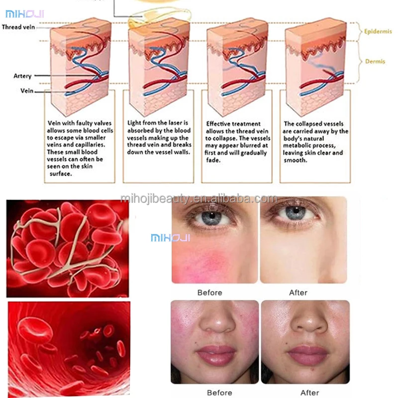 1470 nm body slimming korean laser removal spider veins 980nm diode laser spider vein removal machine