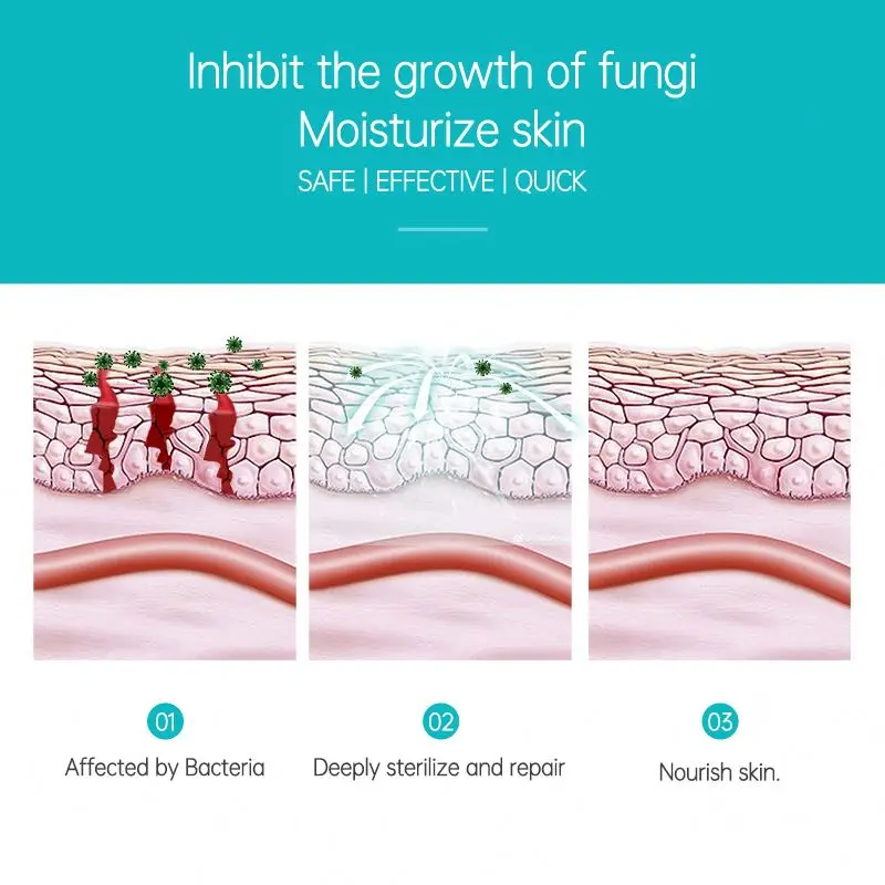 New Arrival Health Care For Psoriasis Treatment Effectively Herbal Cream Topical Ointment For Psoriasis Body Care