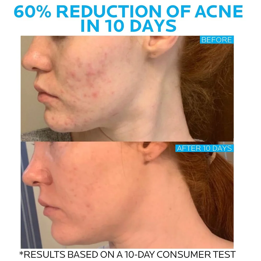 Private Label Natural Acne Cream Skin Care Repair Anti Acne Pimple Removal Salicylic Acid Cream