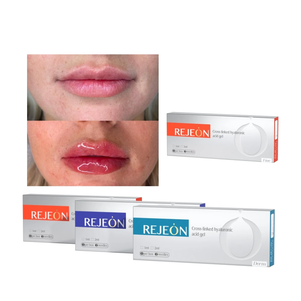 Neuramis HA Hyaluronic Acid Filler Dermal Filler Facial Filler for Forehead Nose Lips facial