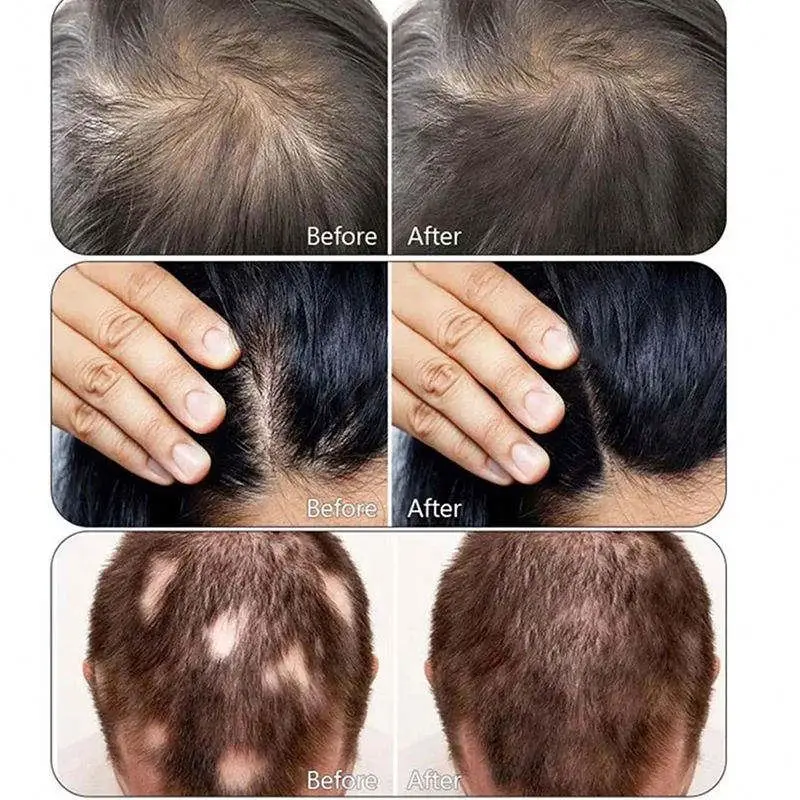 Hair Microcamera Scalp Trichology Analysis Ozone Plasma Machine For Growth Protein Treatment Regrowth Biostimulation