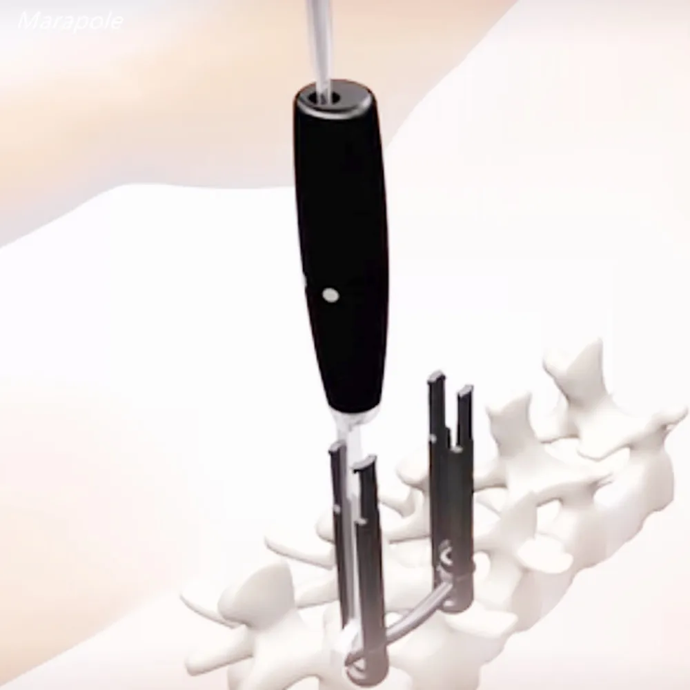 Minimally invasive spinal surgery Spinal fixation system