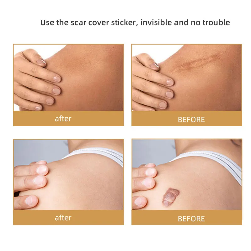 Waterproof Medical Silicone Scar Sheets Repair skin gel Scar Removal Patch Silicone Scar Tape