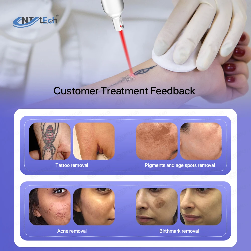 Factory price 1064nm q switch nd yag laser machine laser tattoo removal