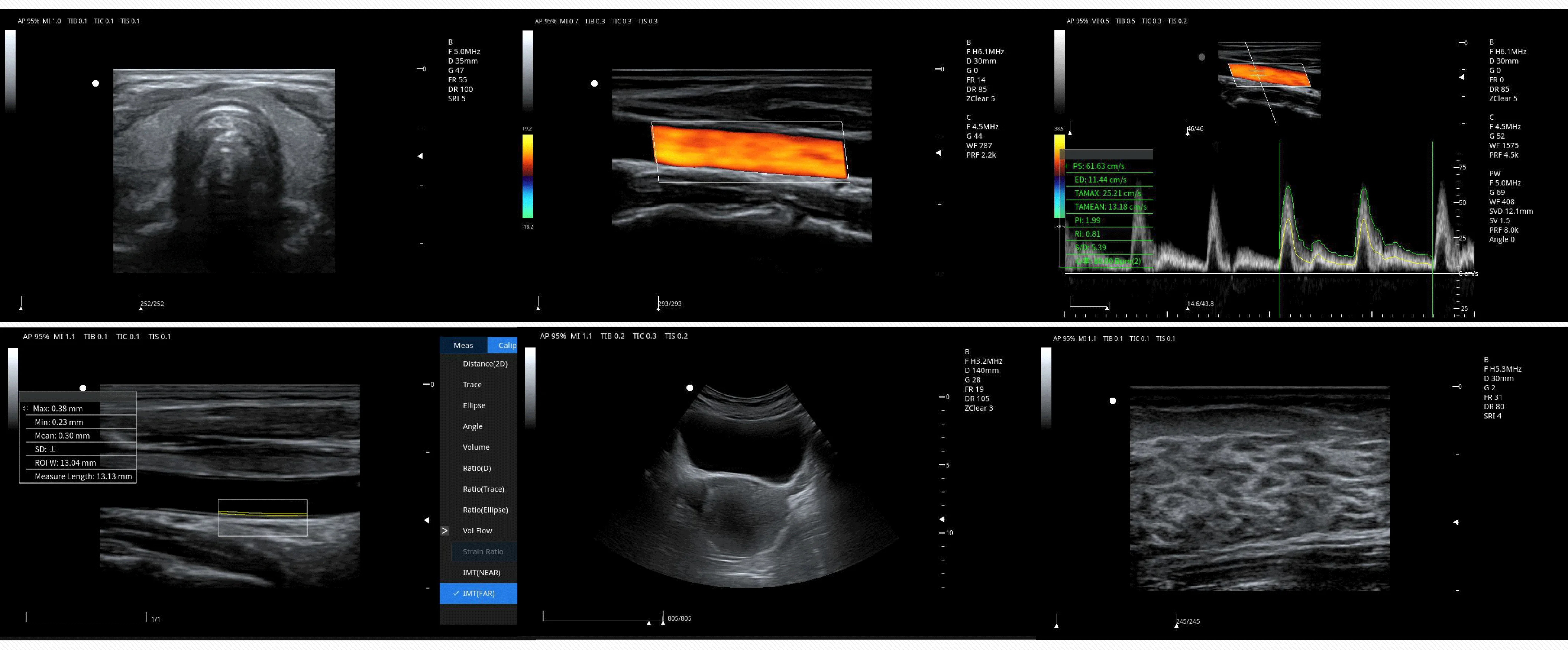 Medico Ecografo Portatil Ultrasonido Portable Color Doppler CW TDI Cardiac Ultrasound Machine Price