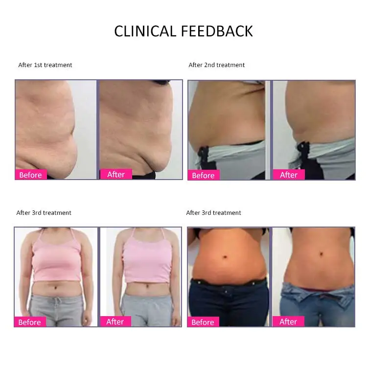 
Anti Cellulite Cavitation RF Machine/body shape Cavitation Machine/Vacuum Cavitation RF System 