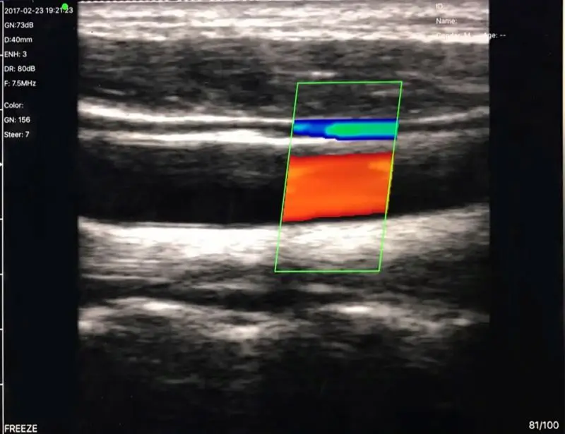 SY-5L Line array wireless probe ultrasound machine hospital medical device color doppler linear probe ultrasound