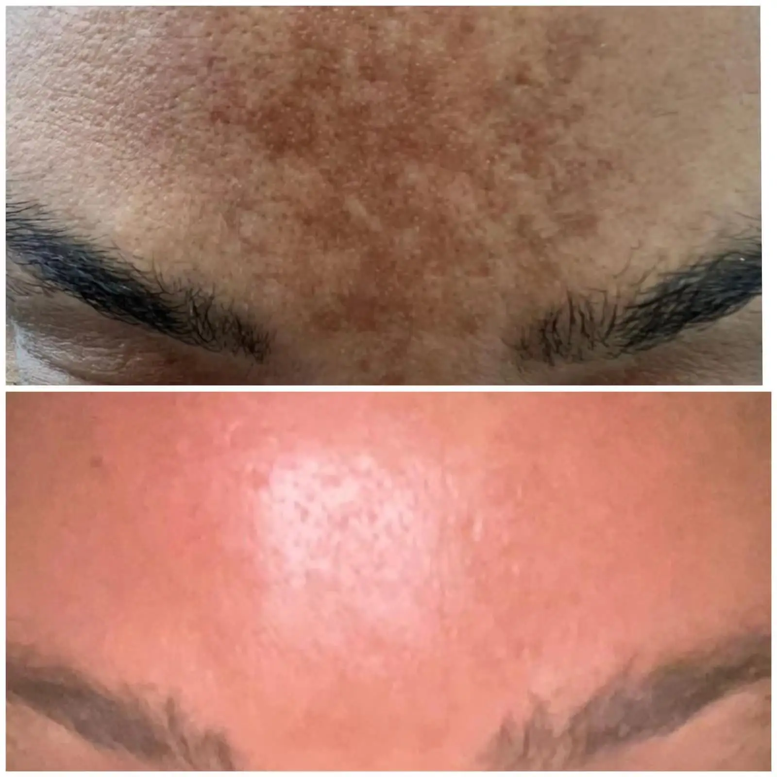 Spongilla Spicule 5Ml Patch Microneedling Scars Seaweed Whitening Melasma Sponge Microneedle Algae Peel Serum For Acne