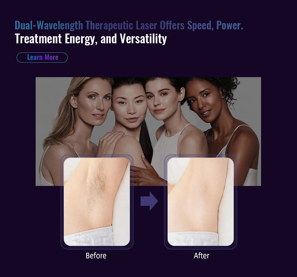 2024 Huamei 3 wavelength Titanium 808 nm Diode Laser 755 808 1064 Ice Platinum Diode Laser Epilator Epilation Machine for Sale