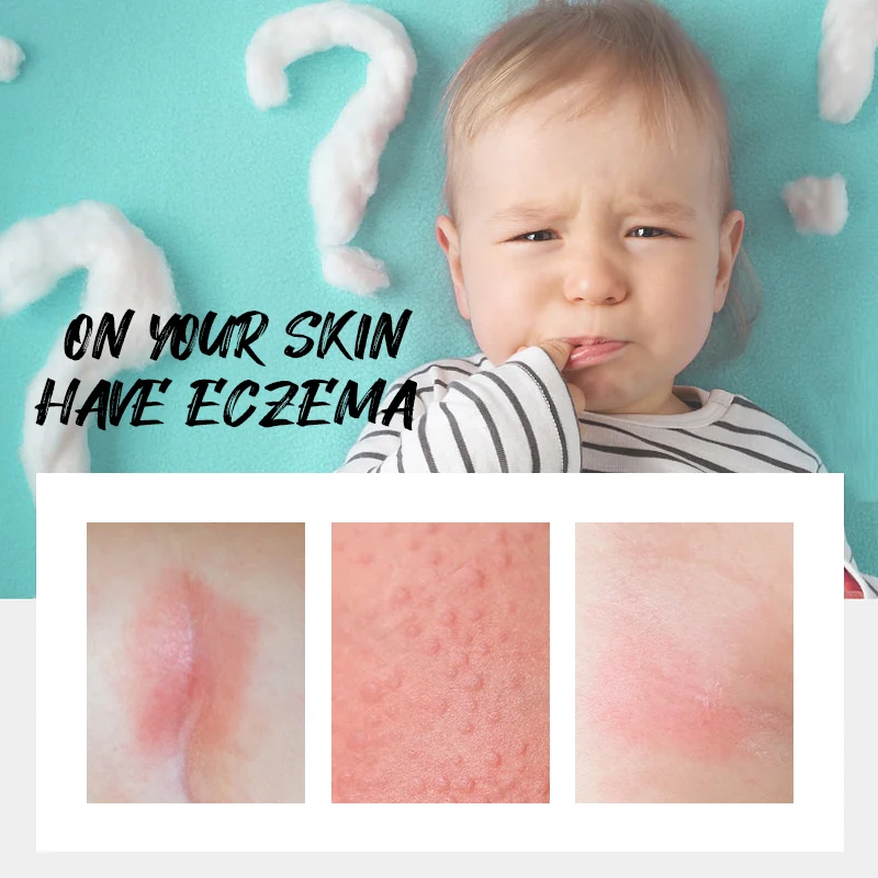 Lanthome Propestional Skin Acne Adult Dermatitis Private Label Natural Baby Psoriasis Herbal Treatment for Relief Eczema Cream