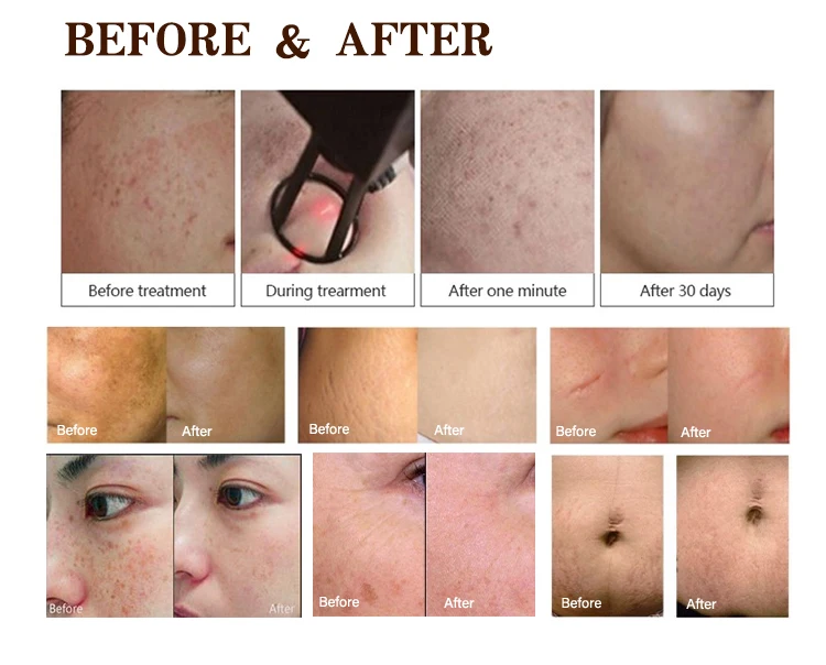 High Quality portable fractional co2 laser equipment co2 fractional laser device Factory price for beauty spa use