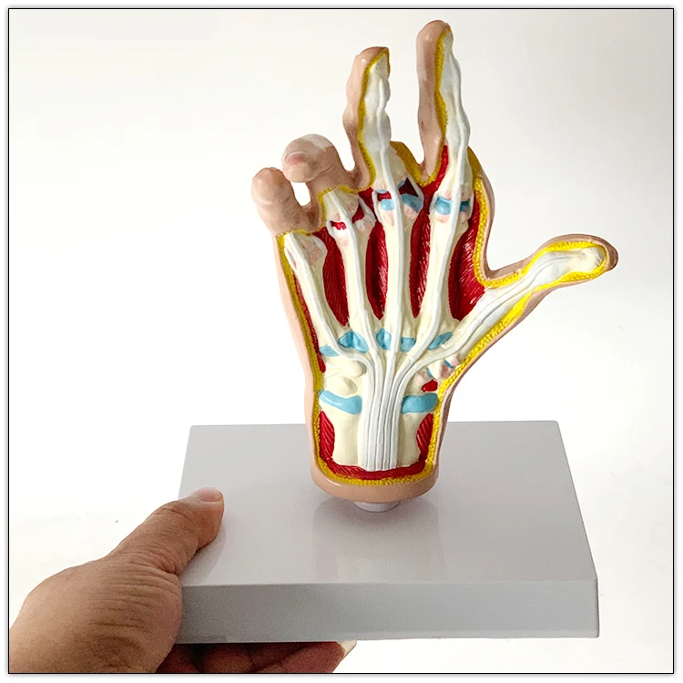 Anatomical model of human hand joint   Arthritis    Rheumatic fever