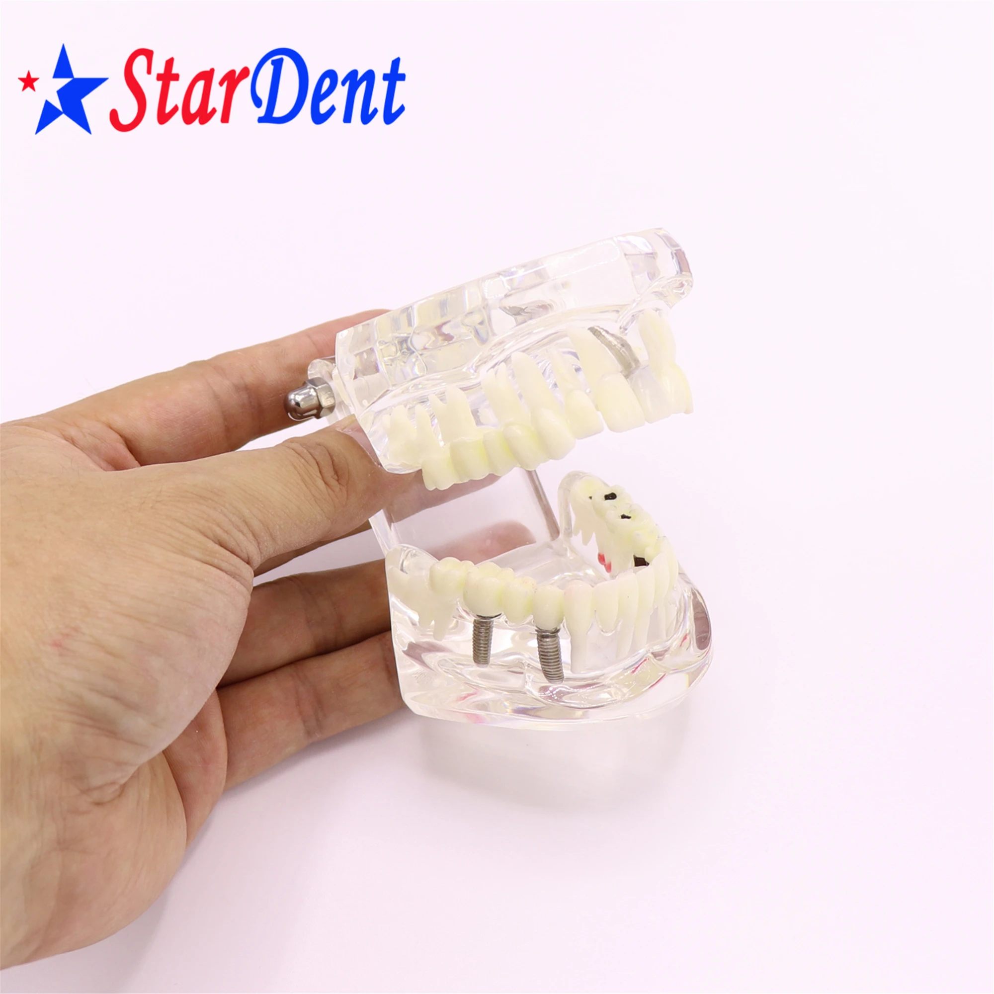 Dental  Teeth Implant Model For Tooth Implant Practicing