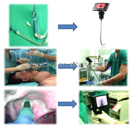 New Style Video Laryngoscope Compare Mccoy Laryngoscope