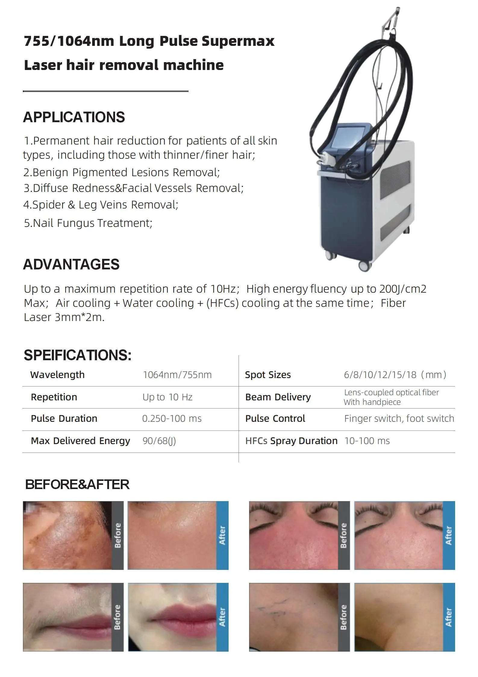 dermatology max alexandrite hair removal device beauty laser gentle alexandrite 755nm laser machine price 1064nm long pulse