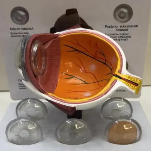 Eye Pathological Anatomical Model For Medical Education Eye Disease Model Of Cataract