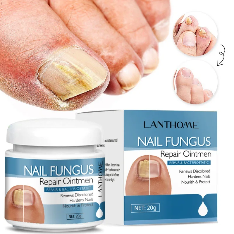 OEM Nail Onychomycosis Fungal Treatment Foot Cream Fungus Removal Cream Paronychia Anti Infection Nails Fungus Repair Ointment