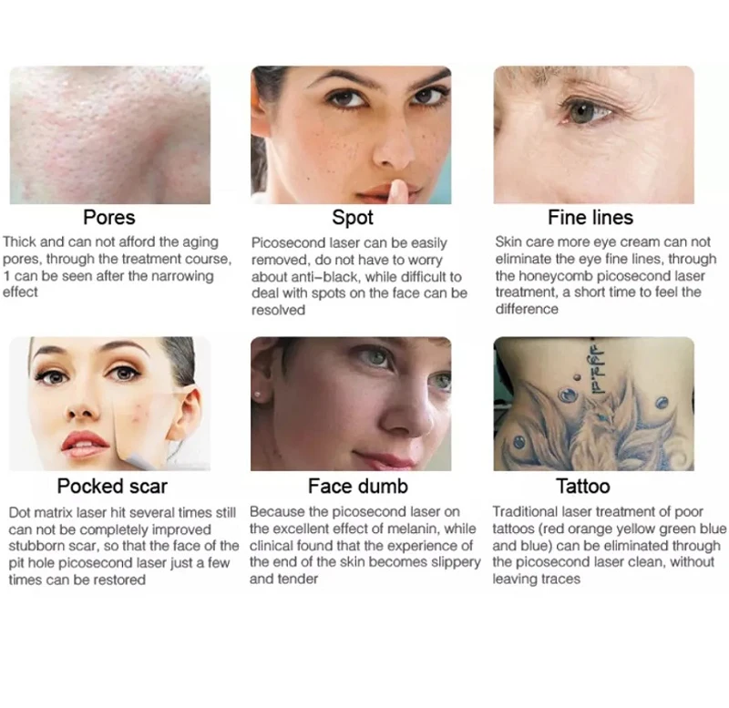 Picosend Q Switched Nd Yag Laser 755nm 808nm 1064nm Laser For All Pigment Removal And Tattoo Removal Picosend Laser Machine