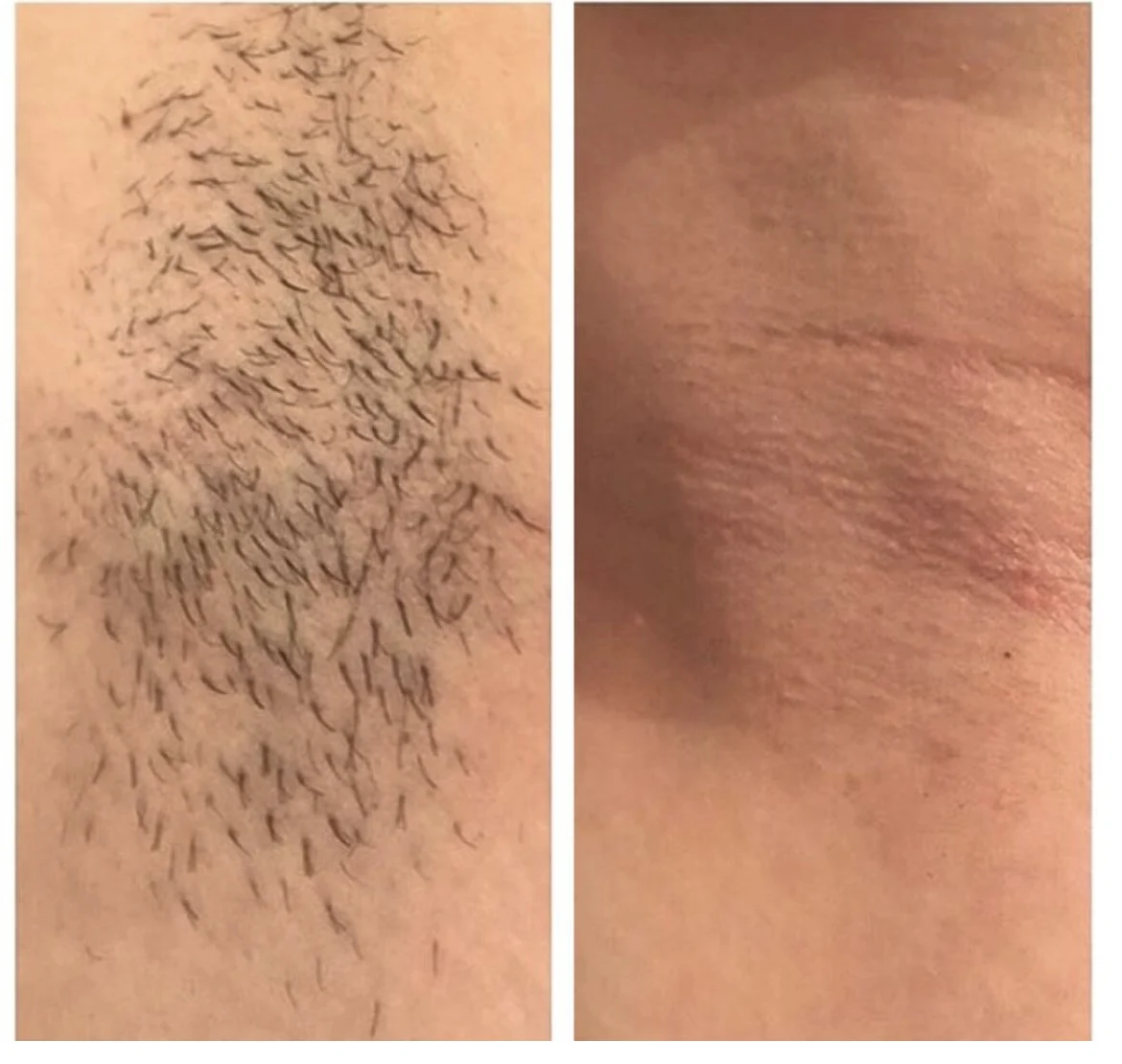 Sincoheren CE approved 808nm diode laser hair removal machine distributor price laser hair removal machine manufacturer