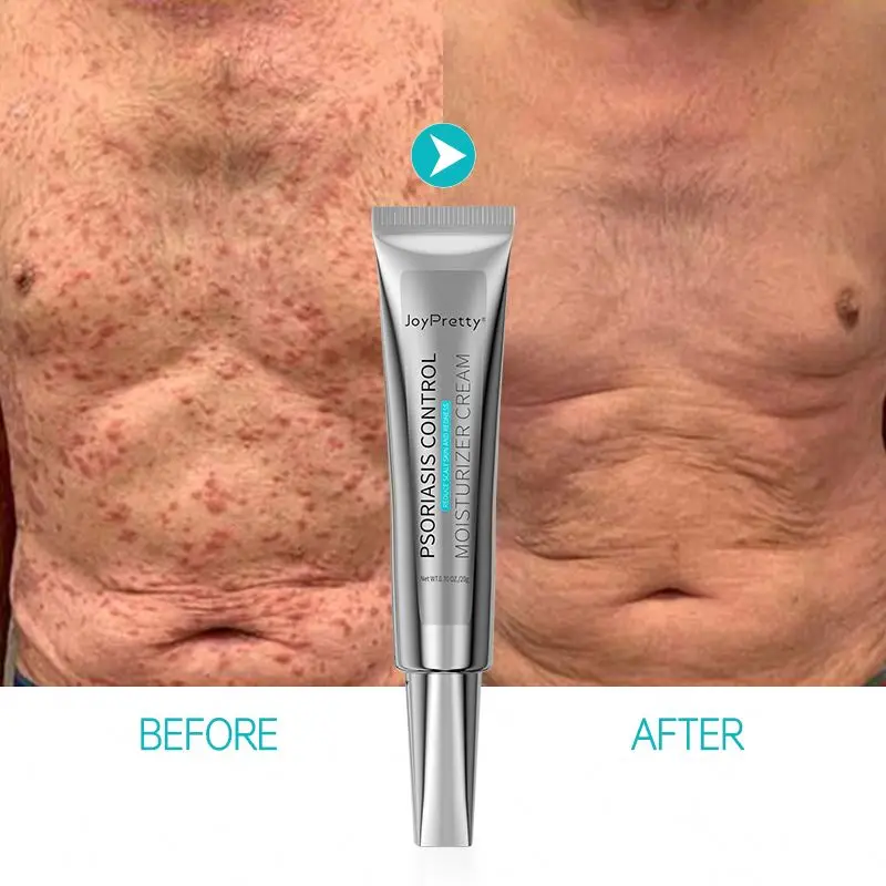 New Arrival Health Care For Psoriasis Treatment Effectively Herbal Cream Topical Ointment For Psoriasis Body Care