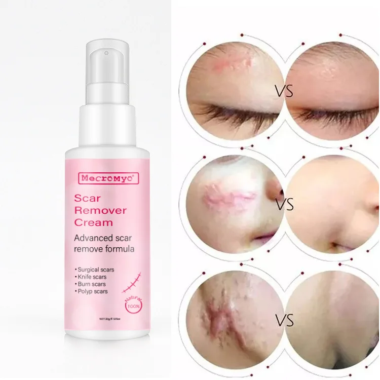 OEM/ODM Private Label Old Scar And Dark Spot On Leg Remover Cream Scars And Acne Marks Remove Cream Pregnancy Scars Acne Cream