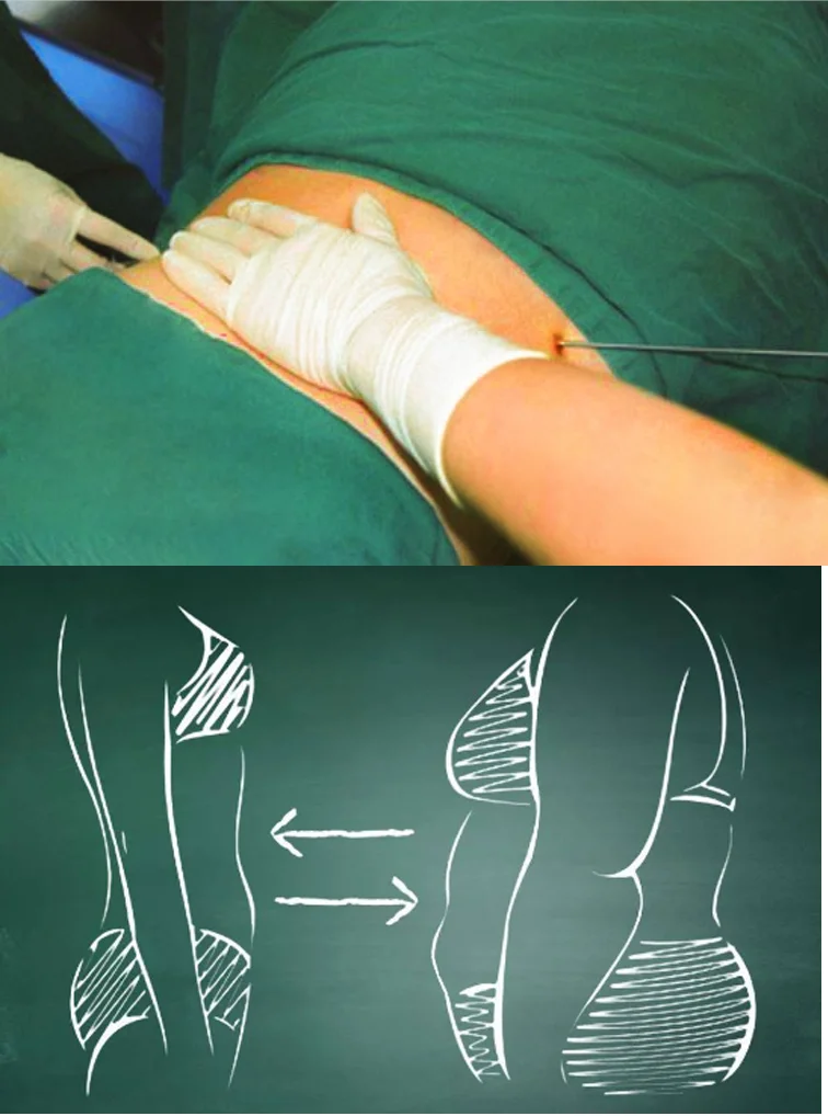 Assisted Surgical Liposuction 1064nm lift face endolaser Optic Fibers Laser Lipolysis Laser Diode1064 Nm Surgery Plastic