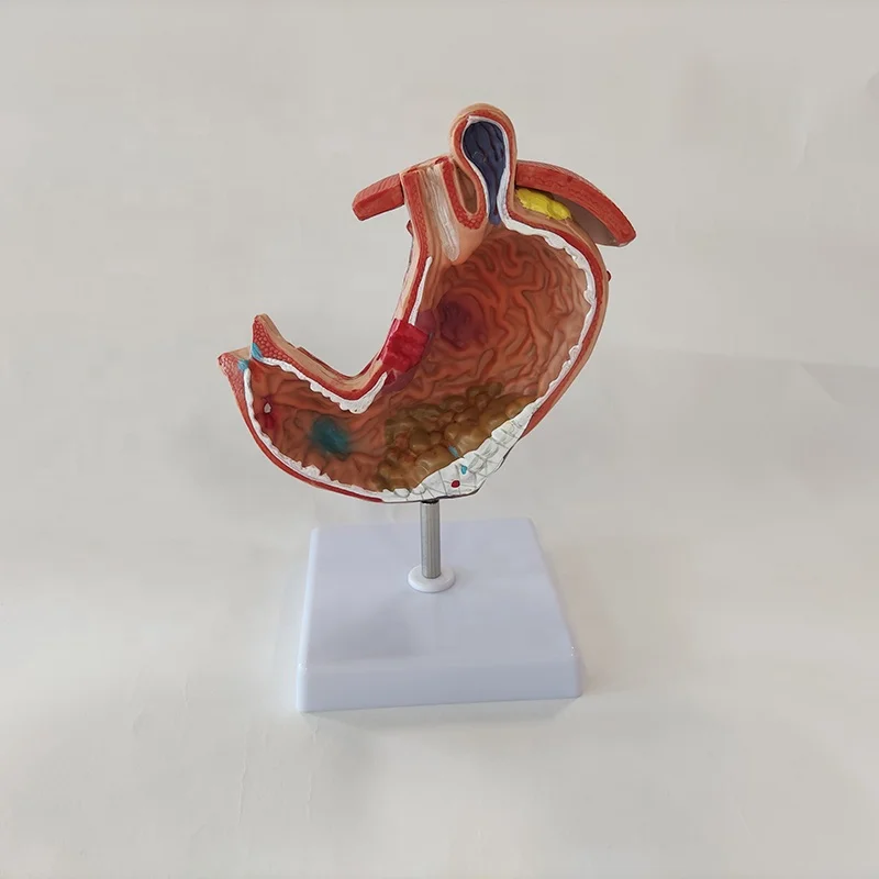 The dissection model of diseased stomach,Pathological gastric model,Gastric disease demonstration model