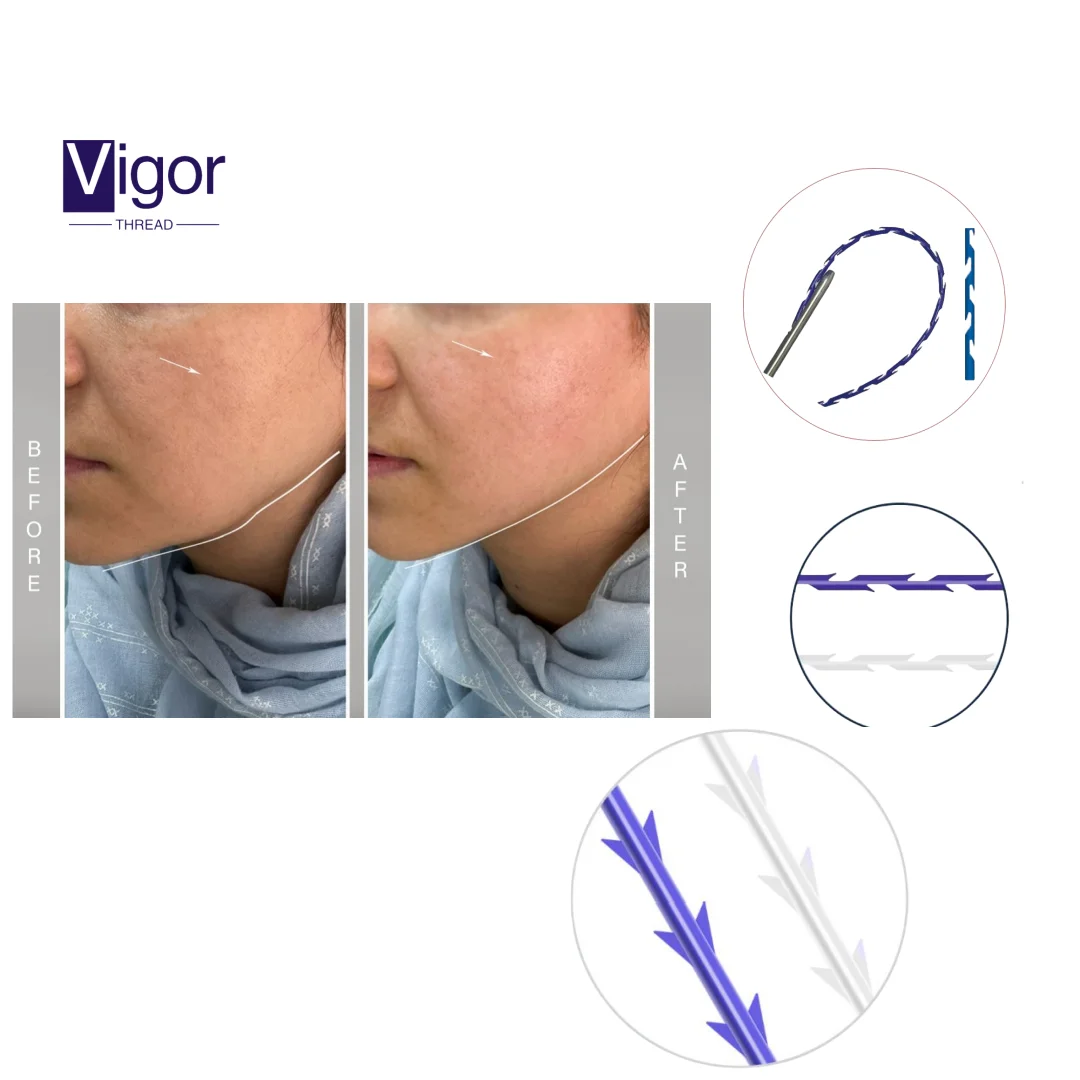 VIGOR wholesale hilos pdo lifting threads korean hilos fishbone mono cog thread lift 8d 18g 100mm korea pdo 3d thread tensioners