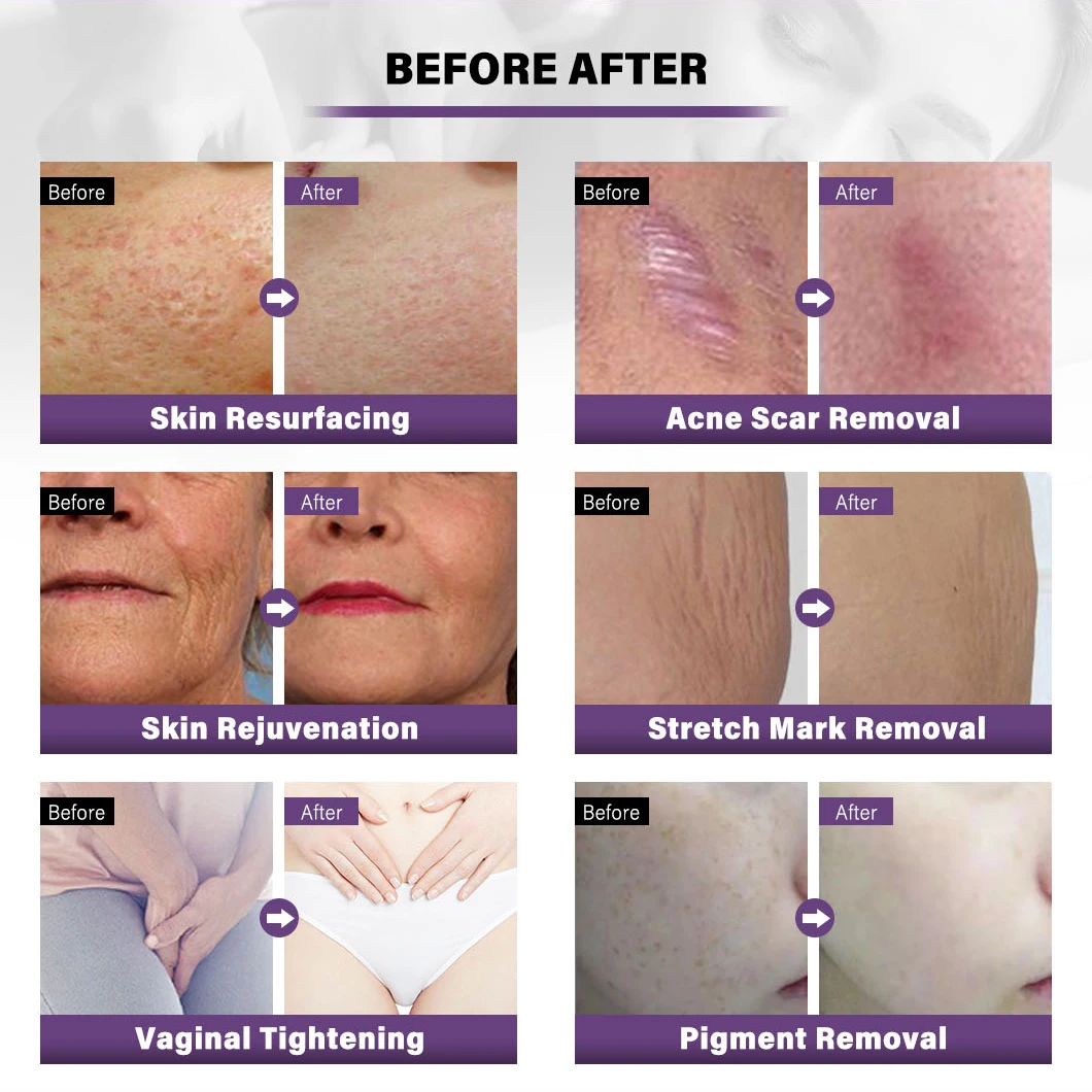 laser CO2 fraccionado Tightening Skin Physiotherapy Equipment 100w co2 laser fractional Beauty machine For Hospital