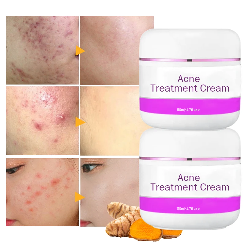 Acne treatment cream Super Lightening Kojic Arbutin Body Snow White Skin Care Intimate Whitening Cream For Sensitive Areas