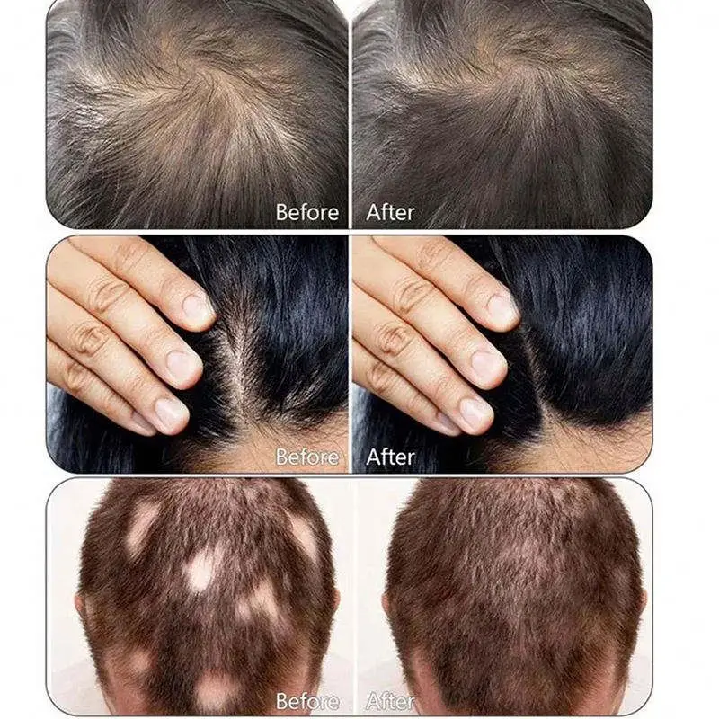 Hottest 15 Inch Screen Portable Hair Treatment Analyzer Scalp Care Analysis Machine For Sale I Restore Growth Regrowth